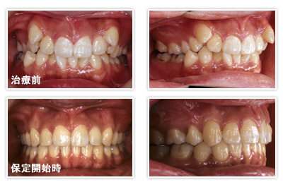 抜歯を伴う叢生治療症例