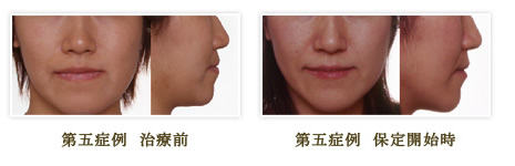 変形を伴う成人下顎前突（非外科的治療症例）（治療の前後の様子）