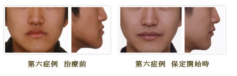 変形を伴う成人下顎前突（外科的治療症例）（治療の前後の様子）