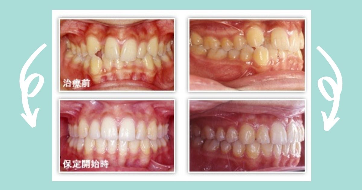 噛み合わせ治療のビフォーアフター【症例画像で見る】