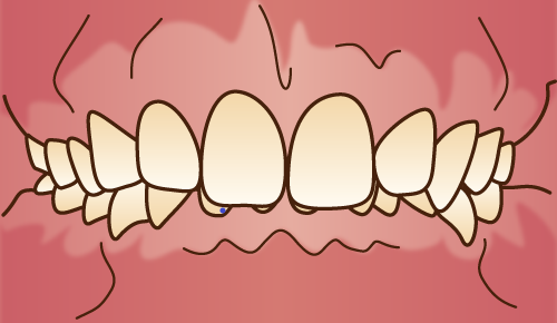 悪い歯並びの状態-過蓋咬合-ディープバイト-噛み合わせが深い画像