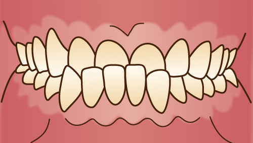 歯並びが悪い状態-下顎前突-下顎が突出した状態