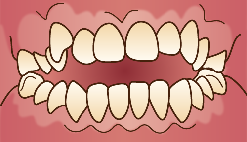 悪い歯並びの状態-開咬-前後の歯が重ならない状態