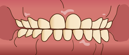 悪い歯並びの状態-切端咬合-上の歯と下の歯がカチカチ当たる状態