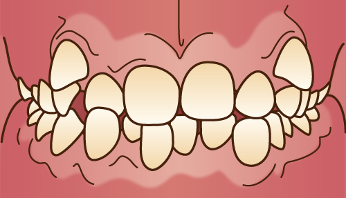 歯並びが悪い状態-叢生-歯並びが凸凹になる状態