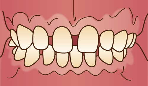 歯並びが悪い状態-すきっ歯
