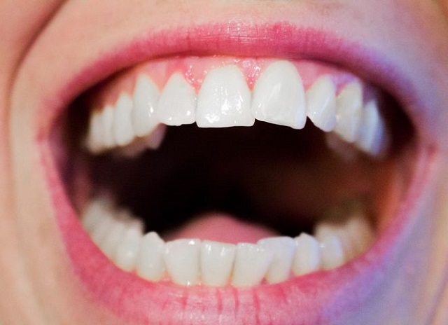 前歯だけの部分矯正は可能か？