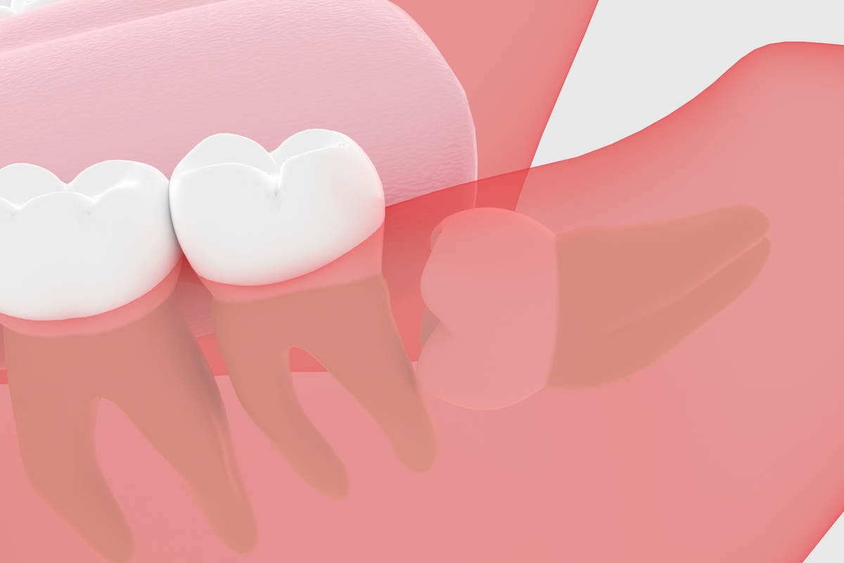 歯列矯正のとき親知らずは抜歯するべき？