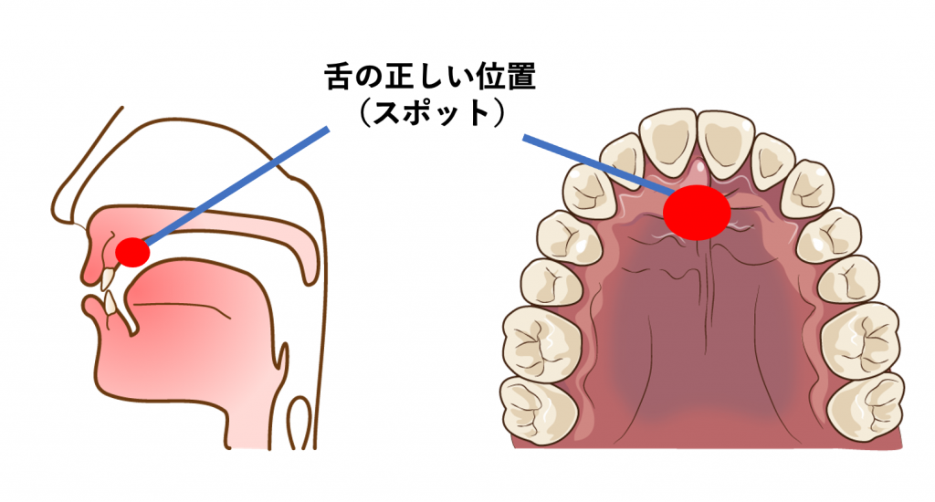 舌の正しい位置をチェック！舌トレーニングやMFTについてご紹介 | アリビオ矯正歯科クリニック
