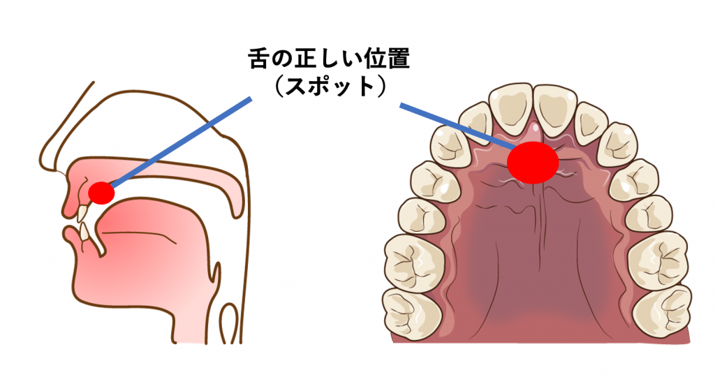 舌 の 位置 矯正 グッズ