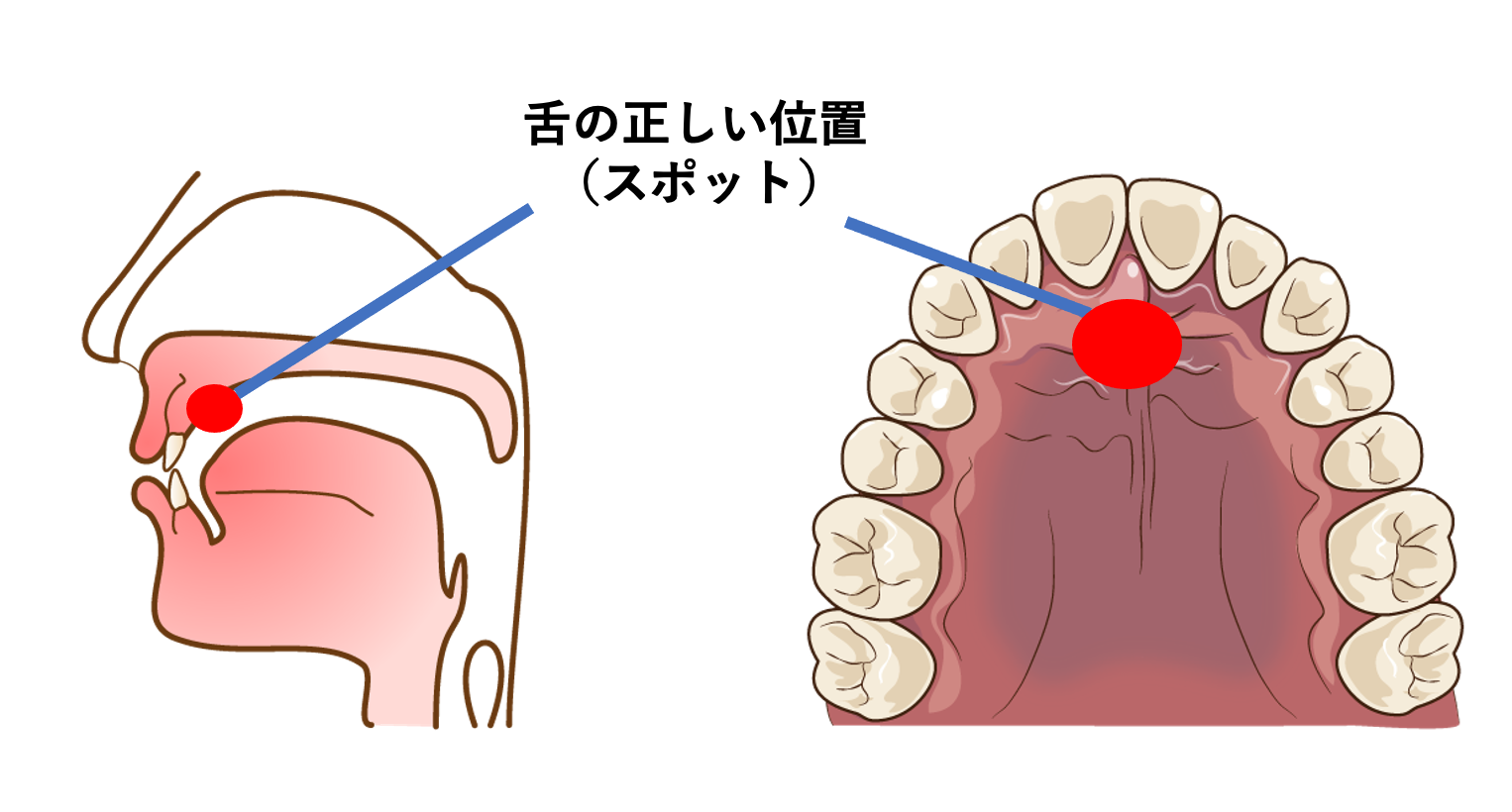 舌の正しい位置の画像