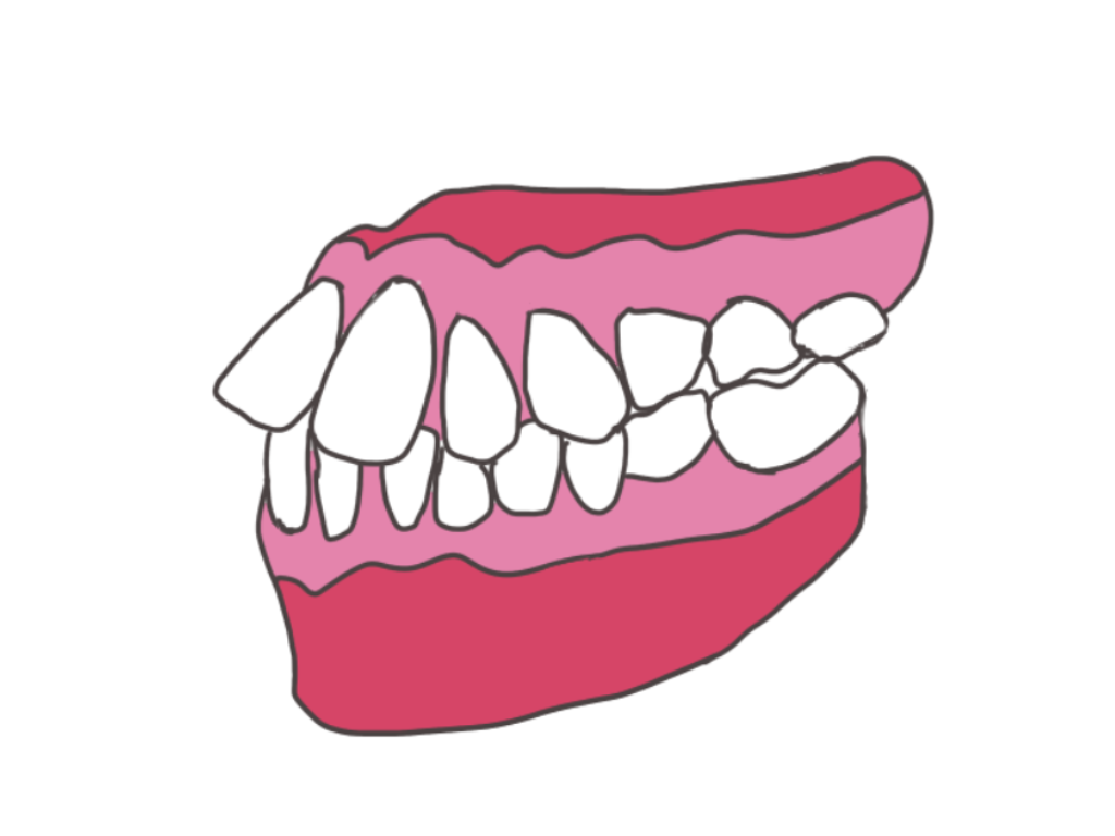 出っ歯に開咬…矯正治療をおすすめする悪い歯並び5種類