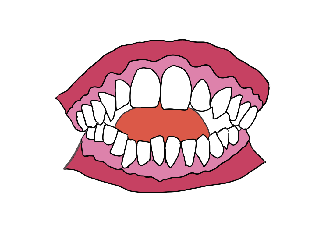 出っ歯に開咬…矯正治療をおすすめする悪い歯並び5種類