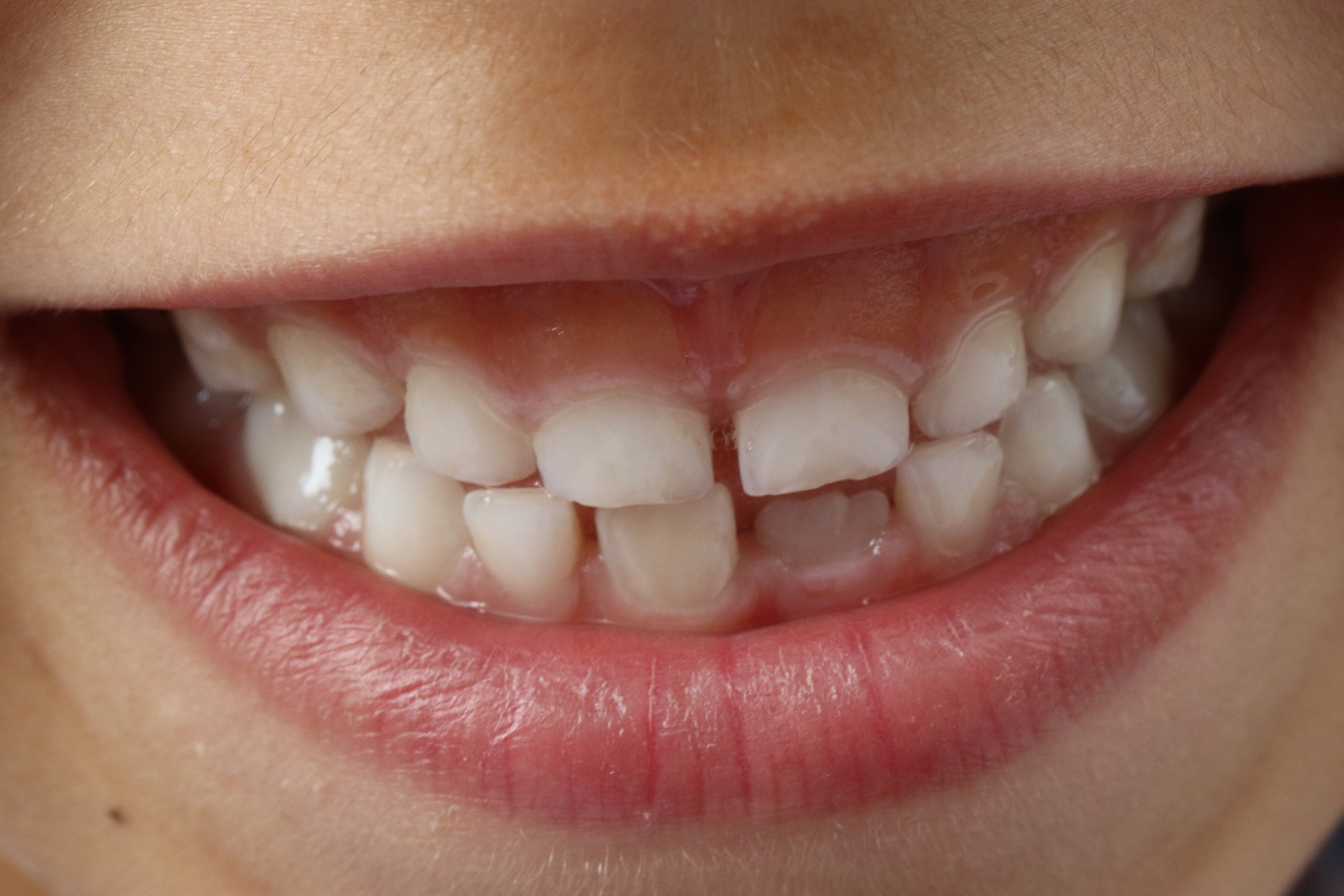 歯の噛み合わせの治し方 ｜子どもの歯並びは自分で治せる？