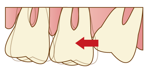 倒れている歯が前方の歯を押す
