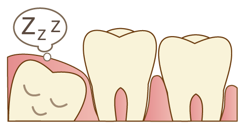 歯ぐきの下で眠っている埋伏歯