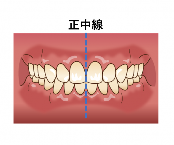 正中線のずれ