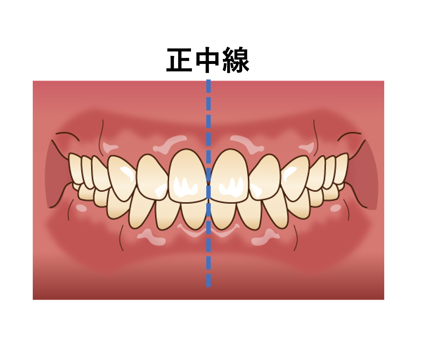 噛み 合わせ ずれ 治し 方