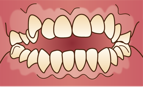 歯並びが悪い状態-開咬-オープンバイトの画像