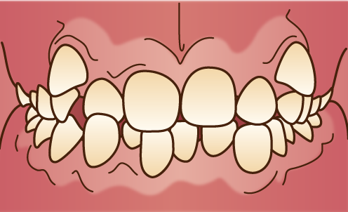 叢生-乱ぐい歯-八重歯の歯並びが悪い画像