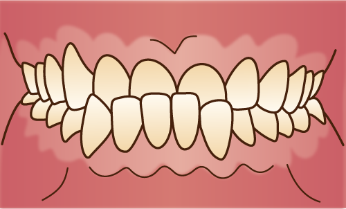 歯並びが悪い状態-下顎前突-受け口-反対咬合の画像