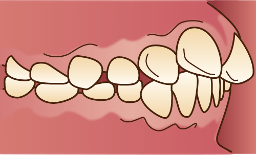 歯並びが悪い状態-上顎前突-出っ歯の画像