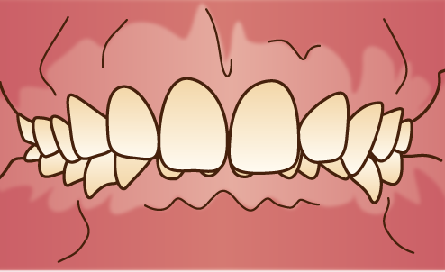 悪い歯並びの状態-過蓋咬合-ディープバイト-噛み合わせが深い画像