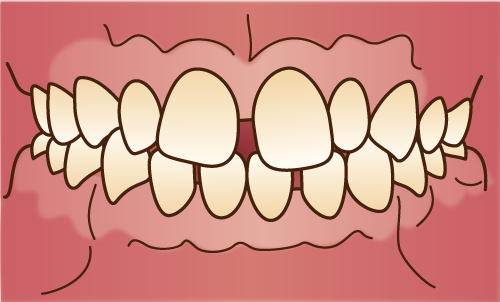 正中離開-すきっ歯-歯並びが悪い状態の画像