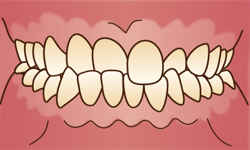 歯並びが悪い状態-交差咬合-クロスバイト-噛み合わせのズレの画像