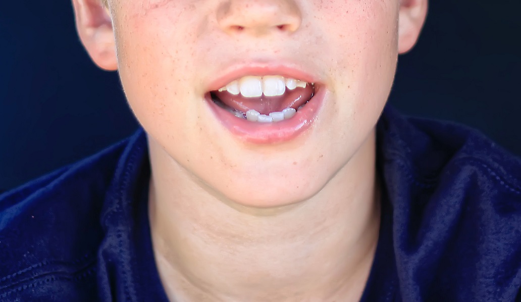 前歯が大きい子どもの画像