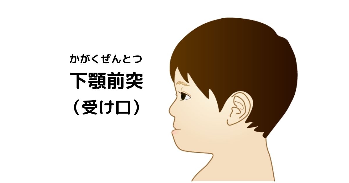 下顎前突・受け口の横顔