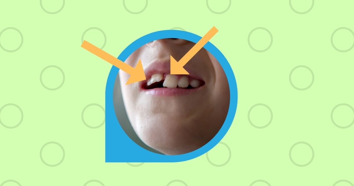 子どもの永久歯が斜めに生えたら？前歯の治療方法や原因を解説