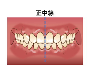 「正中線のずれ」は矯正で治せる？